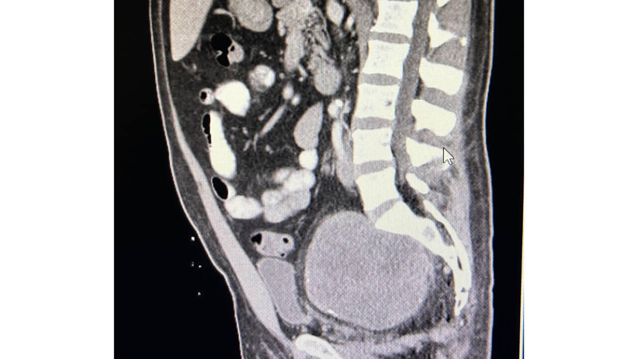 Graphic depicting pre-op sagittal CT imaging scan.